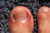 How Running is Affected by Ingrown Toenails