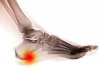 Why It Is Difficult to Detect Heel Spurs