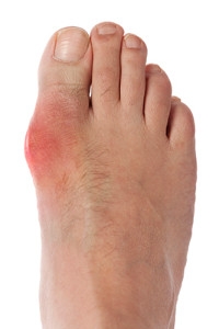 What Foods to Avoid if You are Afflicted with Gout