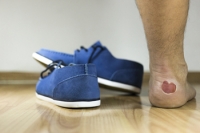 Causes for Blisters on the Feet