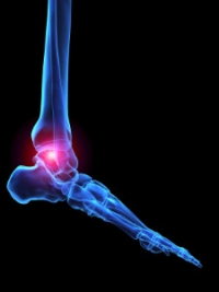 Arthritis and Joint Foot Pain